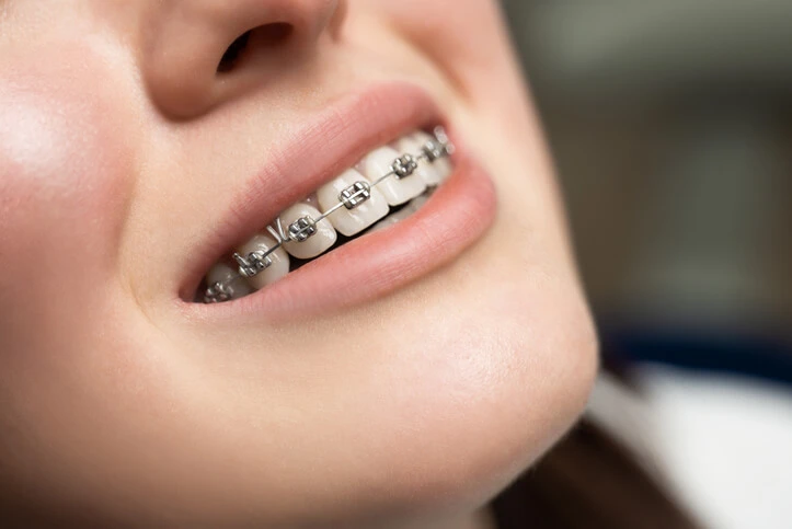 orthodontic treatments