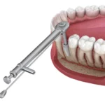 primary stability of implant