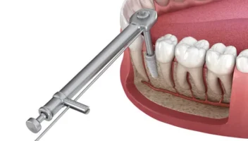 primary stability of implant