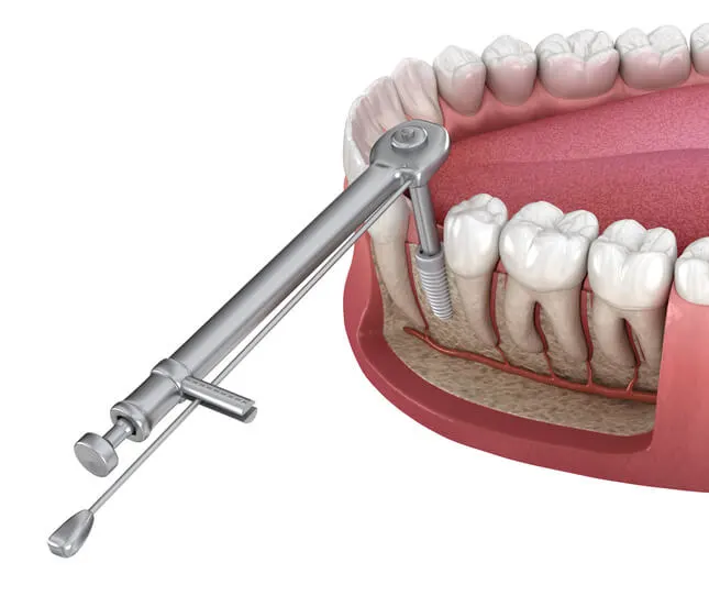 primary stability of implant