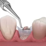 ridge augmentation