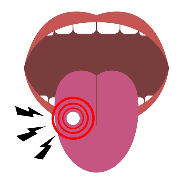 tongue irritation