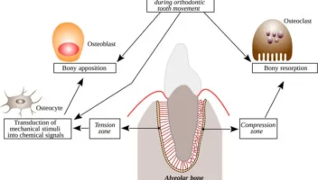 tooth movement