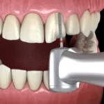 veneer preparation