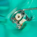 access cavity