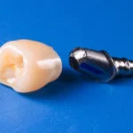 customized and prefabricated abutments