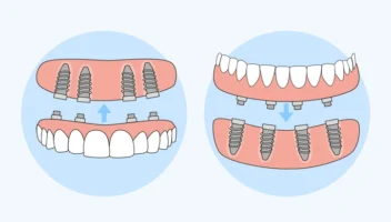 immediate loading implants