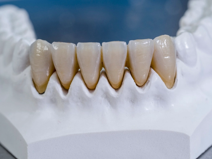 monolithic zirconia crowns