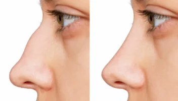 rhinoplasty