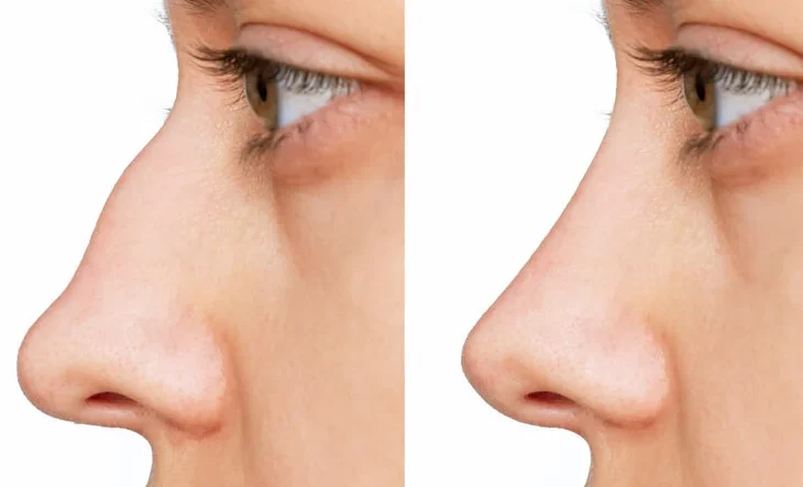 rhinoplasty