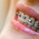 self-ligating braces