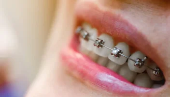 self-ligating braces