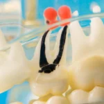 internal root resorption