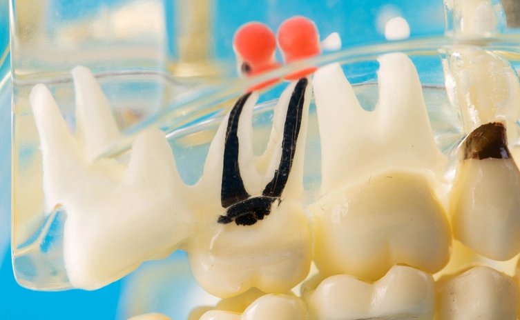 Internal Root Resorption: Diagnosis and Management