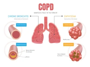 COPD