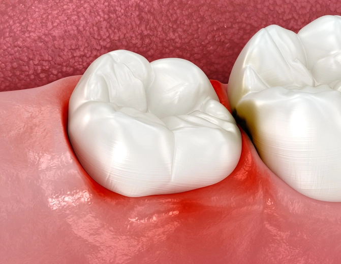 food impaction teeth