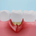 furcation defects