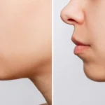 genioplasty