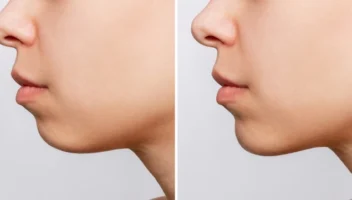 genioplasty