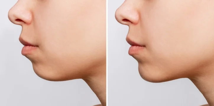 genioplasty