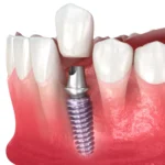 implant design