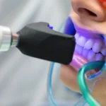 in-office bleaching