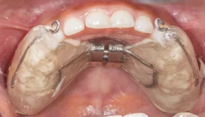 jaw growth modification