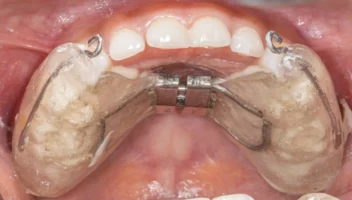 jaw growth modification