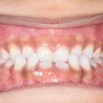 Gingival depigmentation