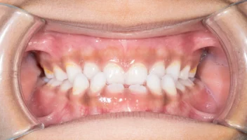 Gingival depigmentation