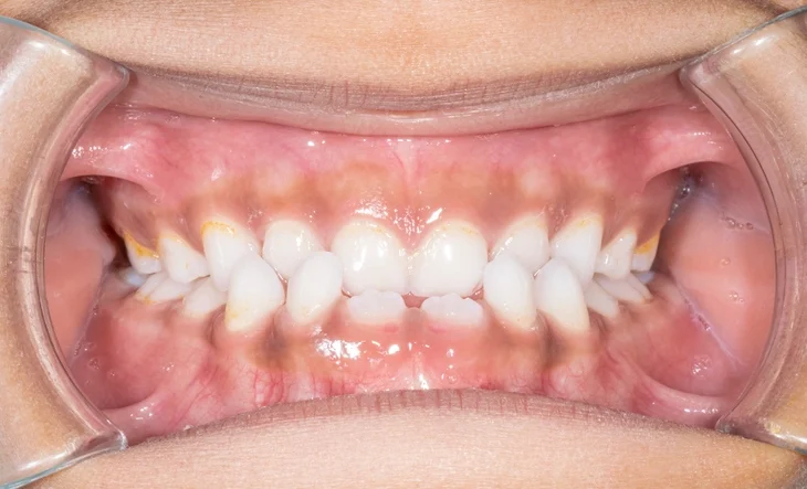 Gingival depigmentation