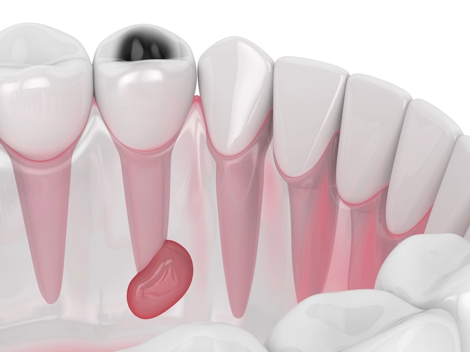Periapical lesions