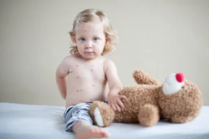 chickenpox