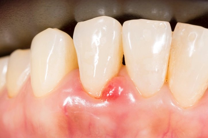 gingival cysts