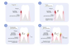 periodontal pockets