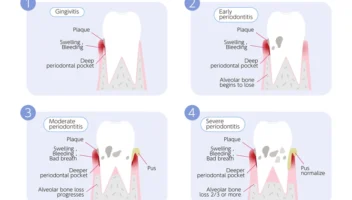 periodontal pockets