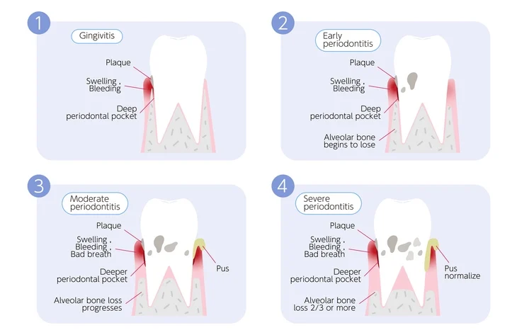 periodontal pockets