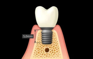 short implants