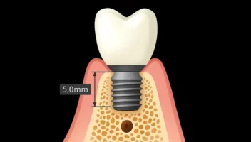 short implants