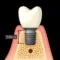 short implants