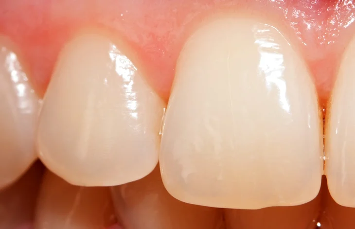 tooth texture