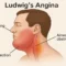 Ludwig’s angina