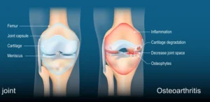 Osteoarthritis