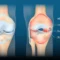 Osteoarthritis