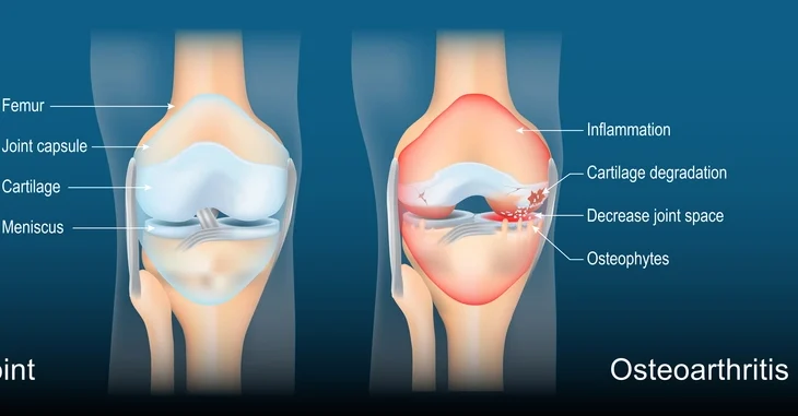 Osteoarthritis