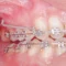 anchorage in orthodontics