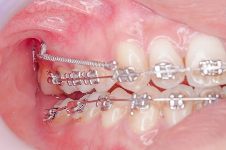 anchorage in orthodontics