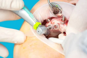 guided implant surgery