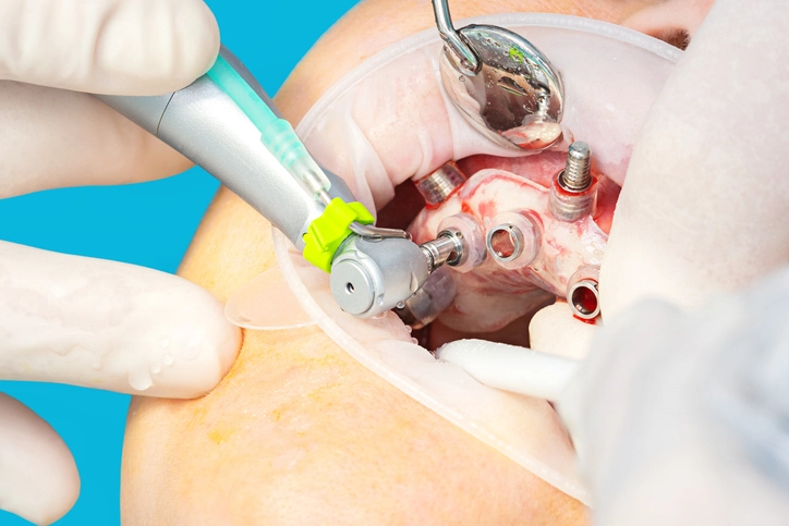guided implant surgery