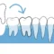 tooth transplant